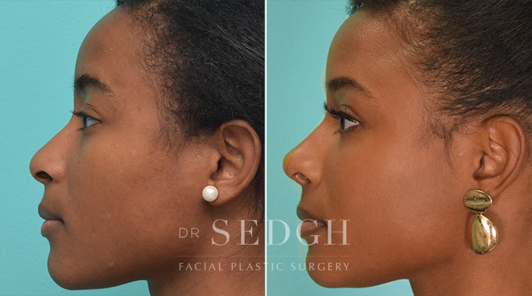 African American Rhinoplasty Before and After | Sedgh