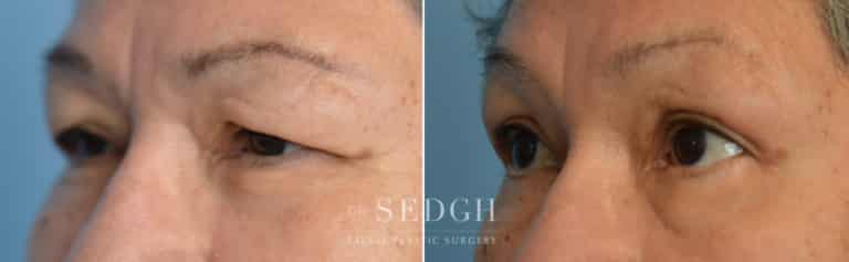 Upper Blepharoplasty Before and After | Sedgh