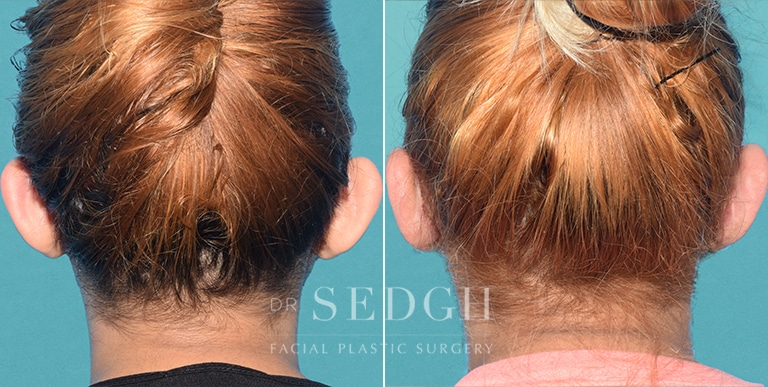 Ear Pinning Surgery Before and After | Sedgh