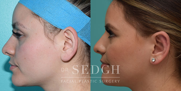 Ear Pinning Surgery Before and After | Sedgh