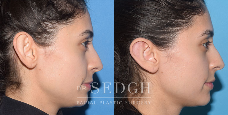 Ear Pinning Surgery Before and After | Sedgh