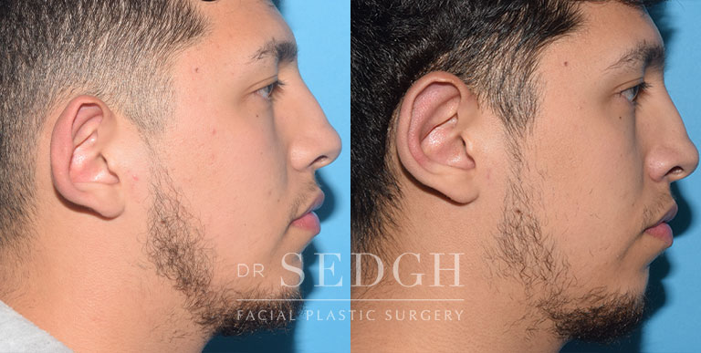 Ear Pinning Surgery Before and After | Sedgh