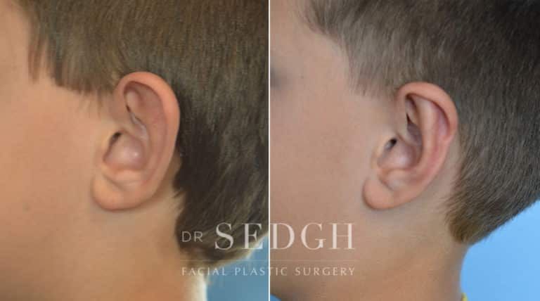 Ear Pinning Surgery Before and After | Sedgh