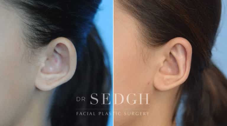 Ear Pinning Surgery Before and After | Sedgh