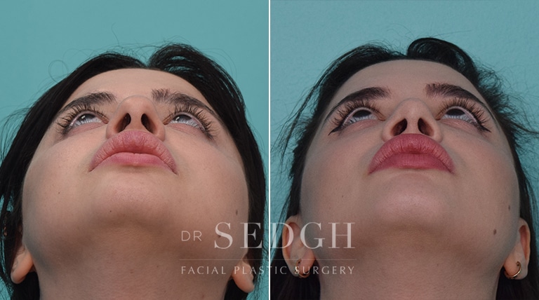 Rhinoplasty Before and After | Sedgh