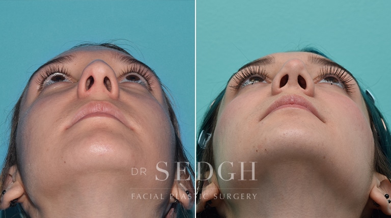 Rhinoplasty Before and After | Sedgh