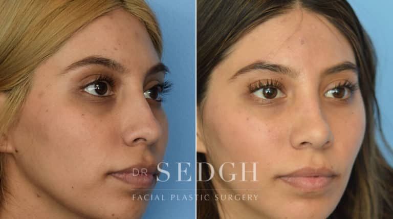 Rhinoplasty Before and After | Sedgh