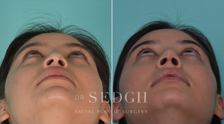 Rhinoplasty Before and After | Sedgh