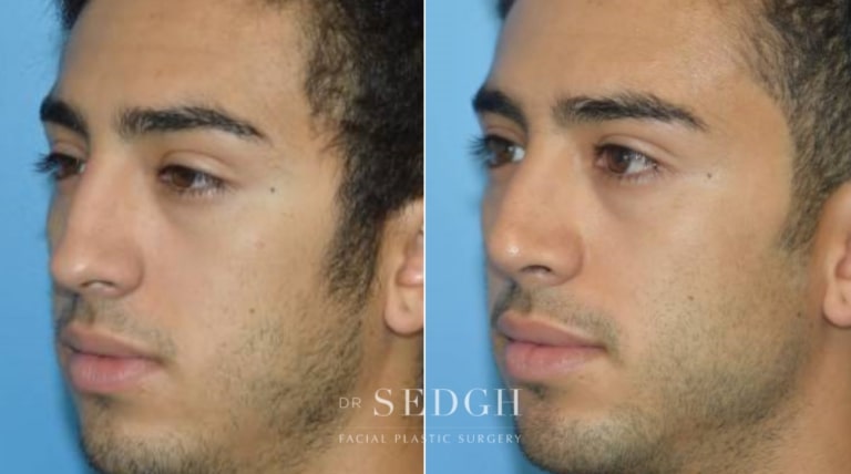 Rhinoplasty Before and After | Sedgh