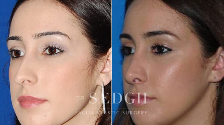 Rhinoplasty Before and After | Sedgh