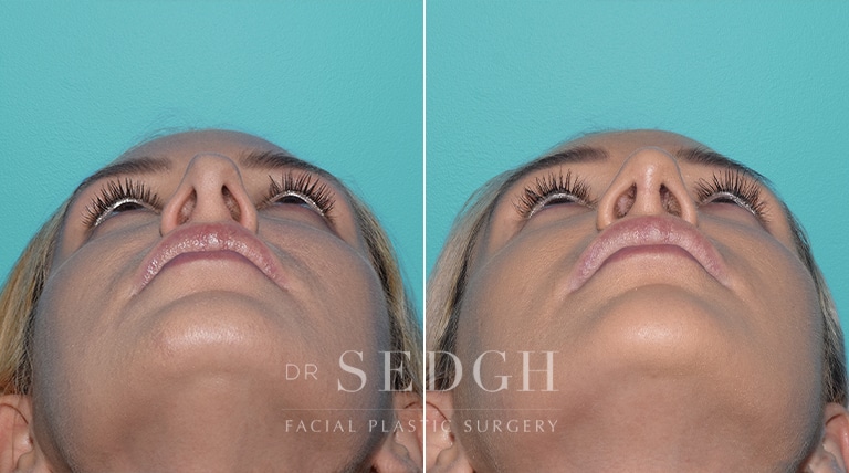 Revision Rhinoplasty Before and After | Sedgh