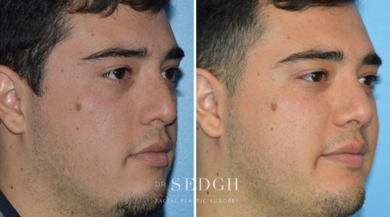 Rhinoplasty Before and After | Sedgh