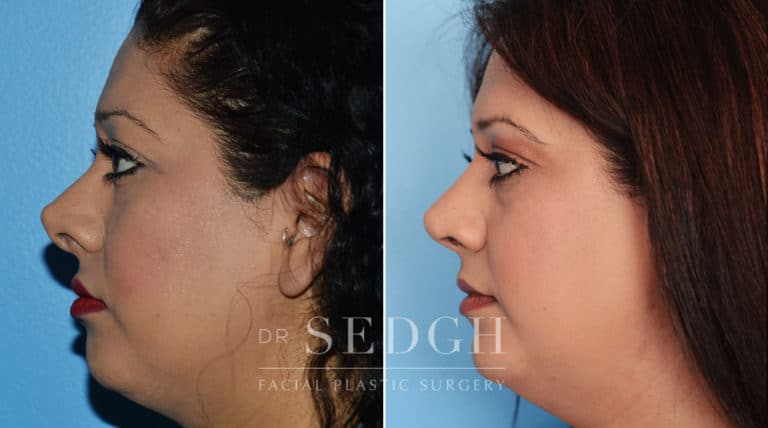 Nasal Fracture Before and After | Sedgh