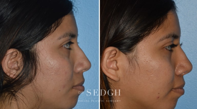 Rhinoplasty Before and After | Sedgh