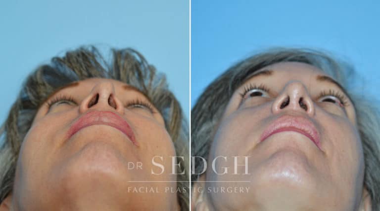 Revision Rhinoplasty Before and After | Sedgh