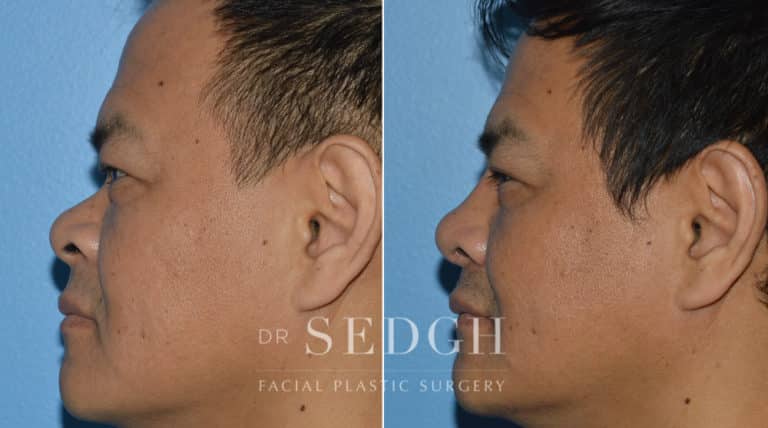 Rhinoplasty Before and After | Sedgh