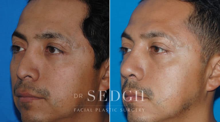 Revision Rhinoplasty Before and After | Sedgh