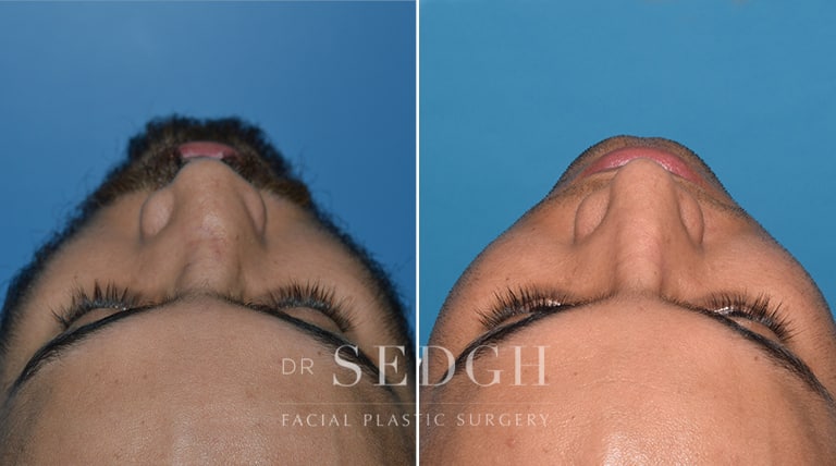 Rhinoplasty Before and After | Sedgh