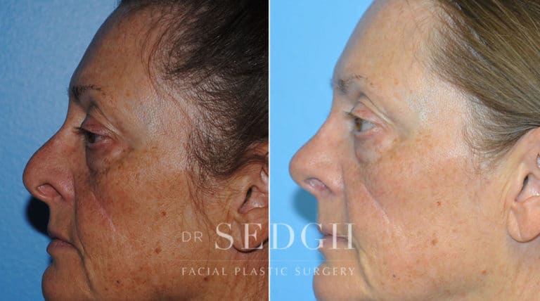 Revision Rhinoplasty Before and After | Sedgh