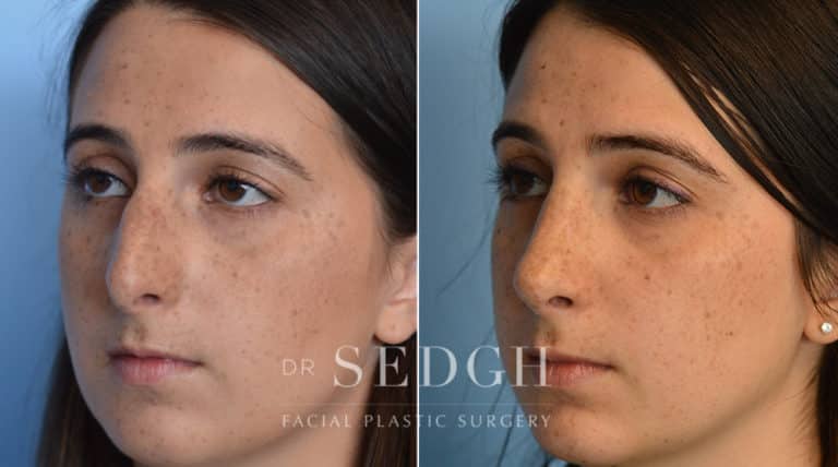 Rhinoplasty Before and After | Sedgh