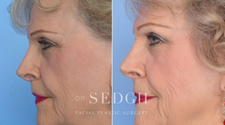 Revision Rhinoplasty Before and After | Sedgh