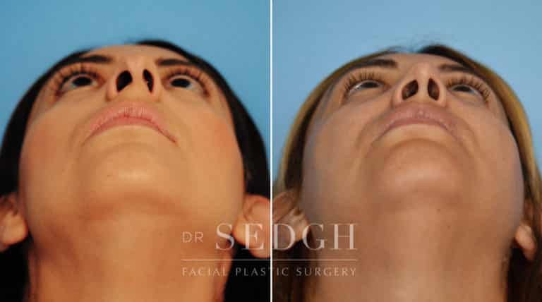 Rhinoplasty Before and After | Sedgh