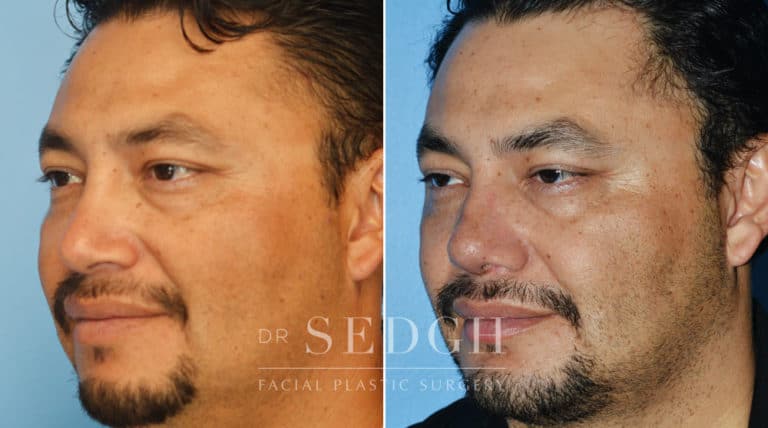 Revision Rhinoplasty Before and After | Sedgh