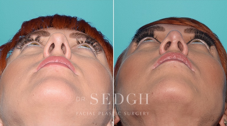 Rhinoplasty Before and After | Sedgh