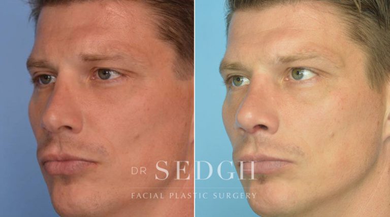 Rhinoplasty Before and After | Sedgh