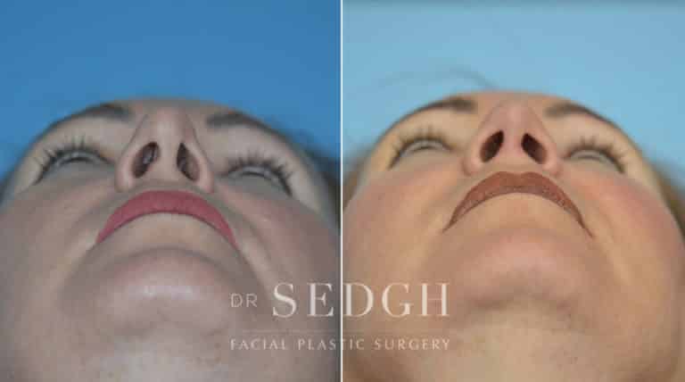 Rhinoplasty Before and After | Sedgh