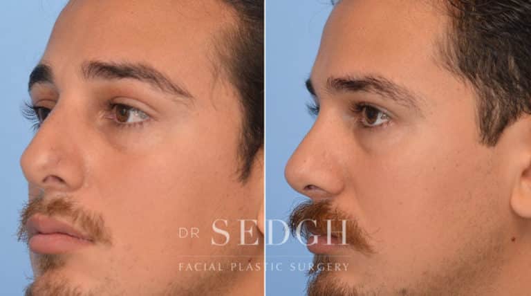 Rhinoplasty Before and After | Sedgh