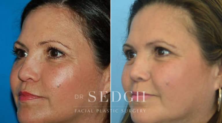 Crooked Nose Surgery Before and After | Sedgh