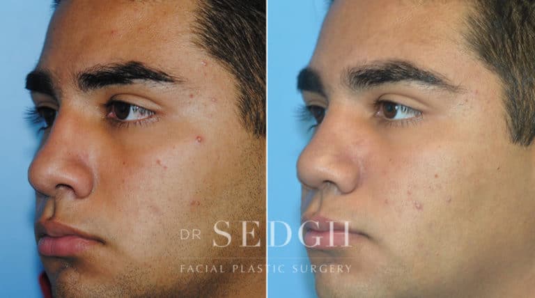 Crooked Nose Surgery Before and After | Sedgh