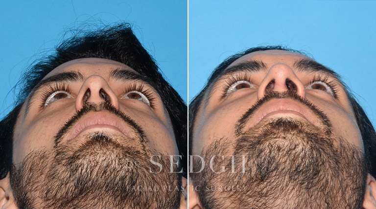 Rhinoplasty Before and After | Sedgh