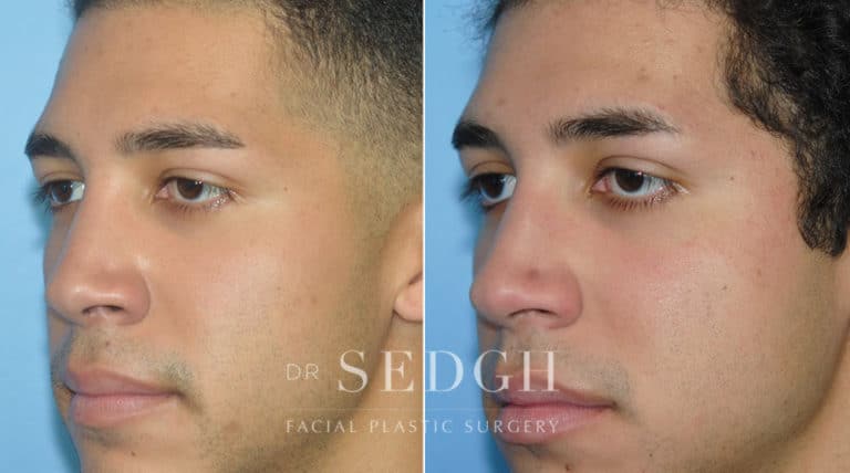 Crooked Nose Surgery Before and After | Sedgh