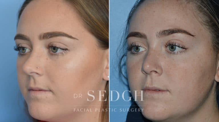 Crooked Nose Surgery Before and After | Sedgh