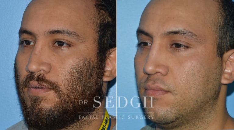 Crooked Nose Surgery Before and After | Sedgh