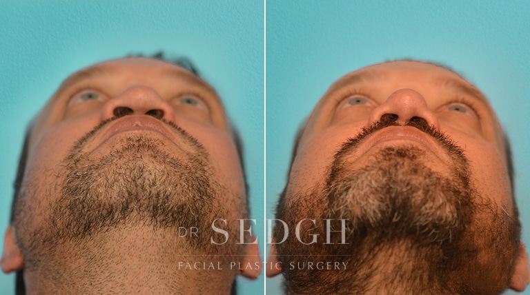 Rhinoplasty Before and After | Sedgh