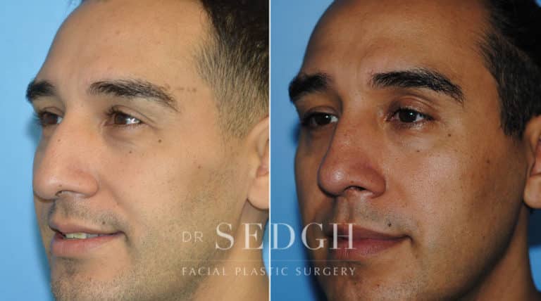 Rhinoplasty Before and After | Sedgh