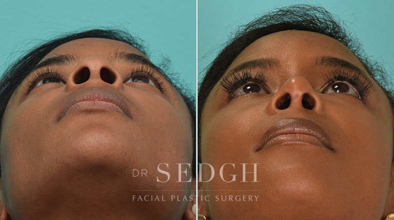 Rhinoplasty Before and After | Sedgh