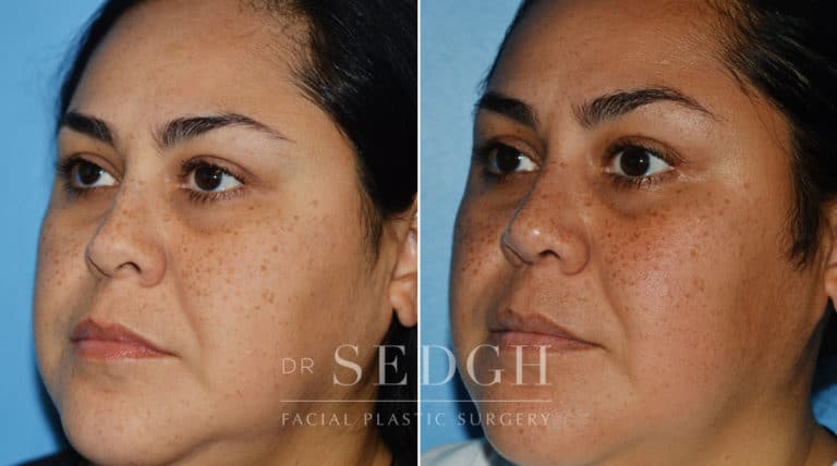 Crooked Nose Surgery Before and After | Sedgh