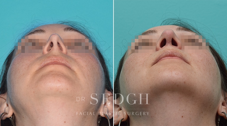 Female Rhinoplasty Before and After | Sedgh