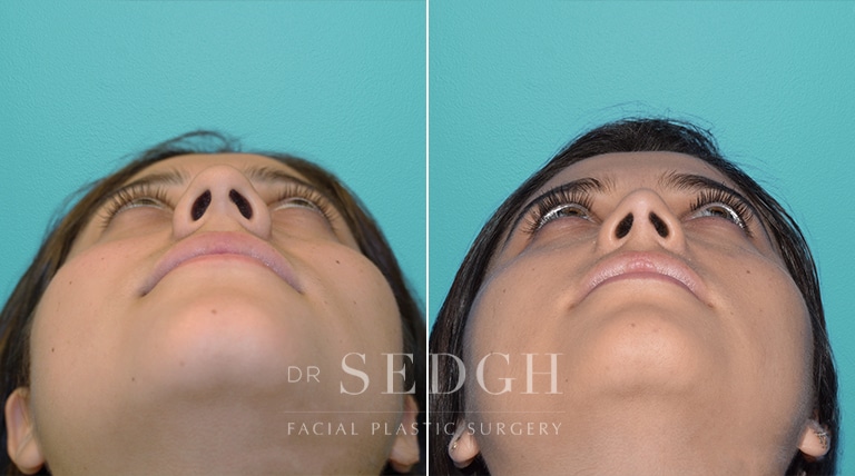 Female Rhinoplasty Before and After | Sedgh