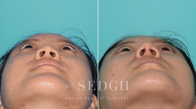 Female Rhinoplasty Before and After | Sedgh