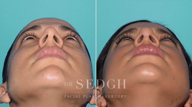 Female Rhinoplasty Before and After | Sedgh