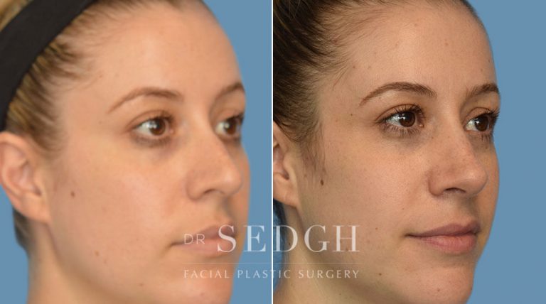 Rhinoplasty Before and After | Sedgh