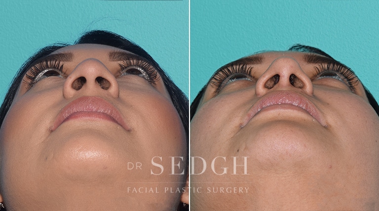 Female Rhinoplasty Before and After | Sedgh