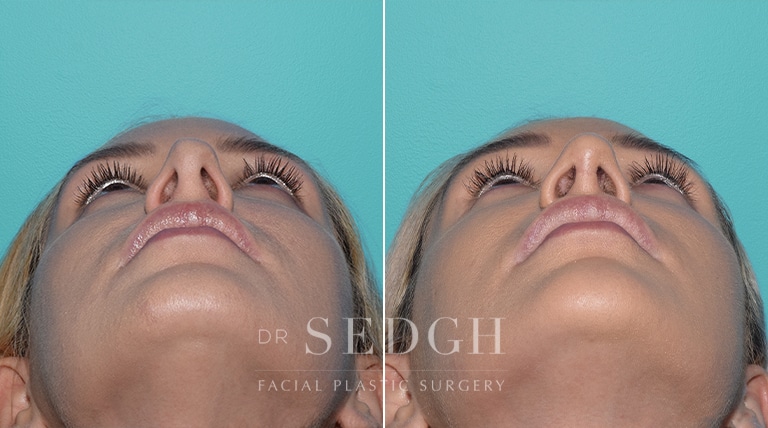 Female Rhinoplasty Before and After | Sedgh