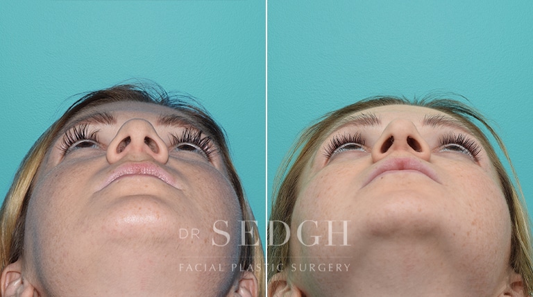 Female Rhinoplasty Before and After | Sedgh