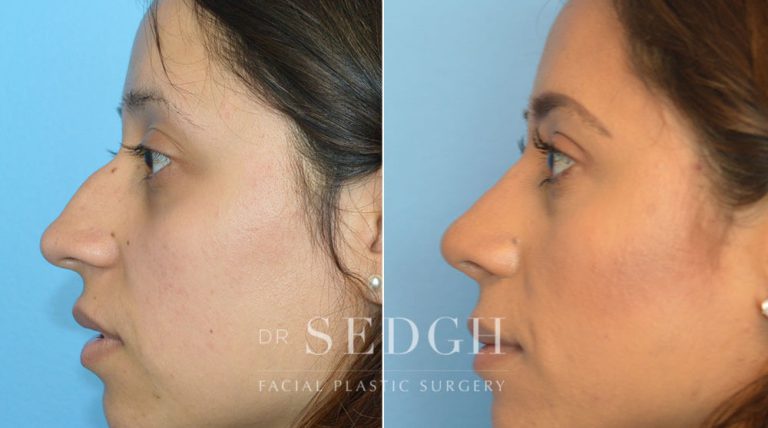 Female Rhinoplasty Before and After | Sedgh